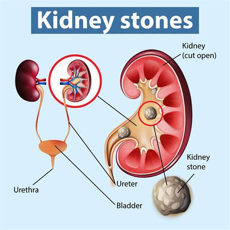 calculus of kidney